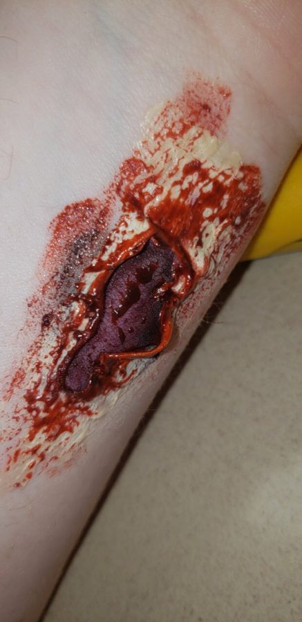 Burn wound created by an anatomy student.